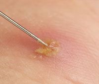 Carbuncles Furuncles And Carbuncles | Plastic Surgery Key