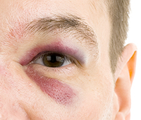 Black Eye Symptoms