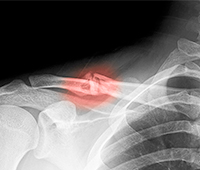 Broken collar bone Causes