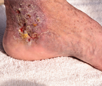 Cellulitis References