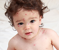 Chicken Pox References