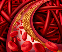 Diabetes and atherosclerosis FAQs
