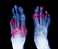 Diabetes and bone-joint problems  References