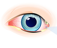 Eye discharge Symptoms