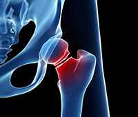 Hip fracture Symptoms