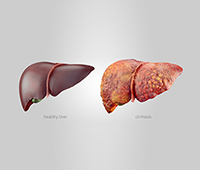 Liver Cirrhosis References