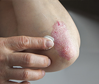 Learn about the diagnosis of Psoriasis