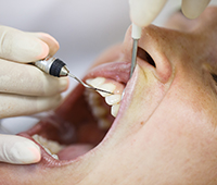 Ayurvedic Treatment for Periodontitis- Pyorrhoea- Gum disease