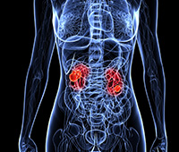 Tuberculosis of the Kidneys Causes