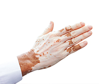 Vitiligo-leucoderma Symptoms