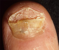 Nail infections Symptoms